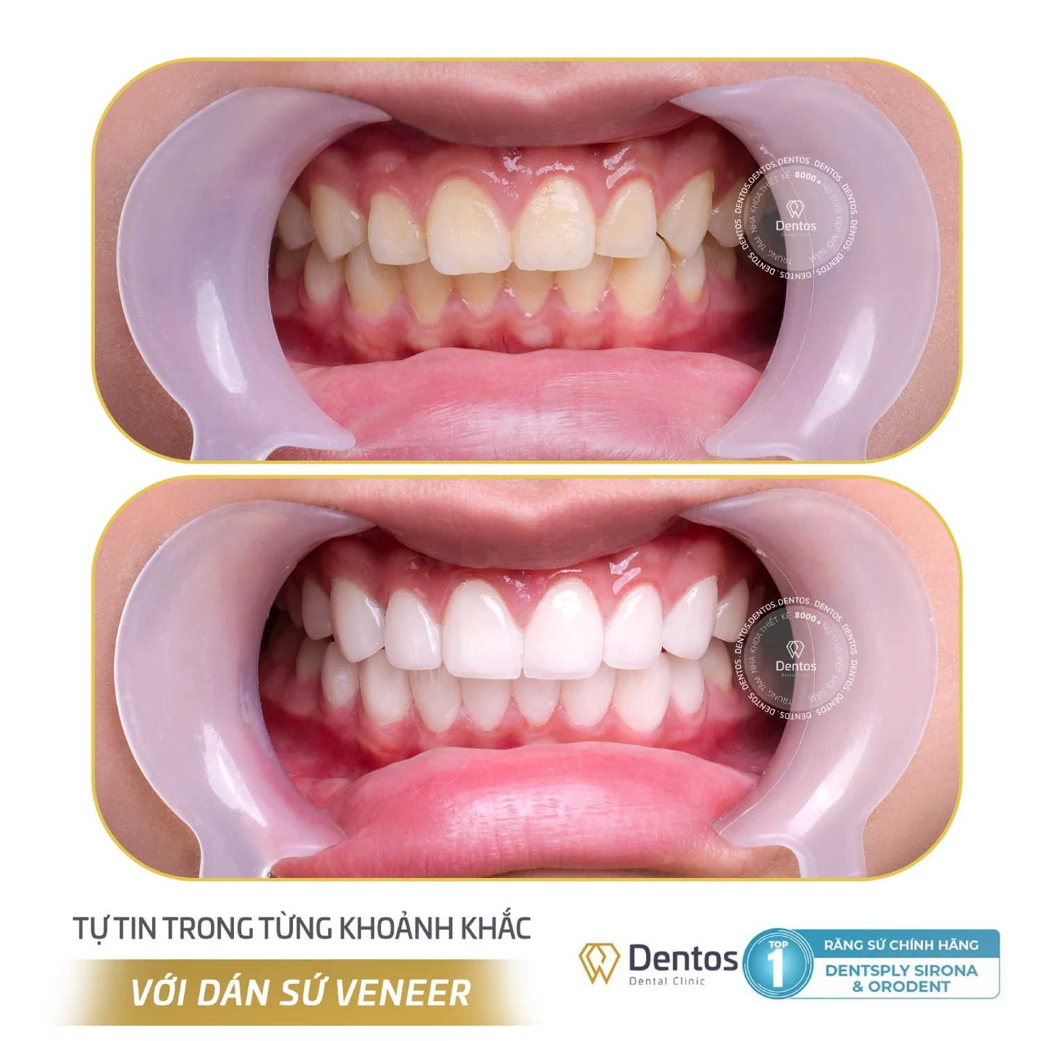 Răng bị ố vàng, xỉn màu hoặc nhiễm kháng sinh nhẹ có thể dán sứ Veneer